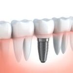 Root Canal Treatment in Lahore