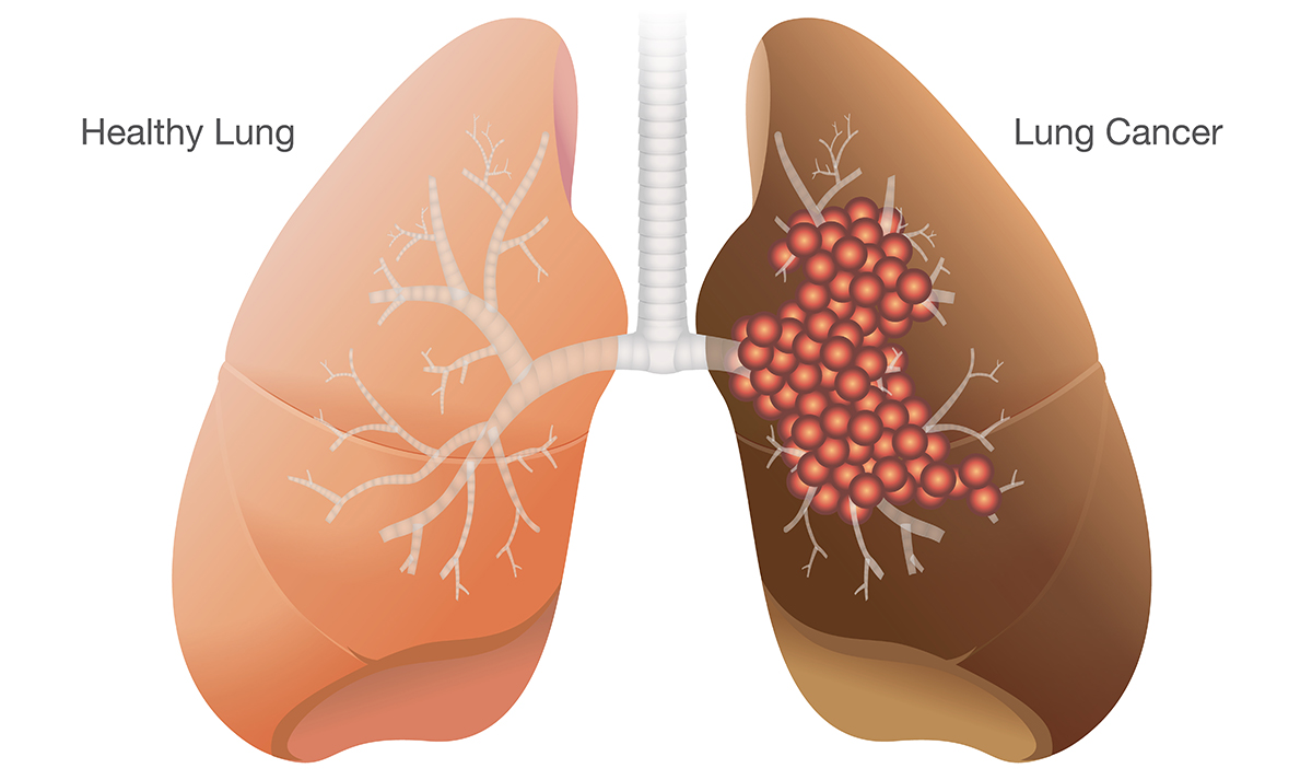 Lung Cancer and What to Look Out For