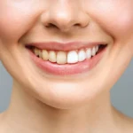Tooth Discoloration