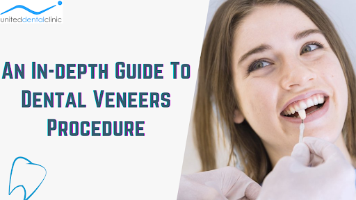 An In-depth Guide To Dental Veneers Procedure