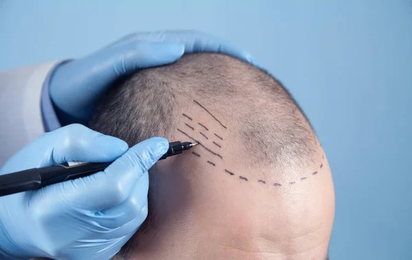 Hair Transplant Turkey by IXORA – The Best Option for Hair Restoration