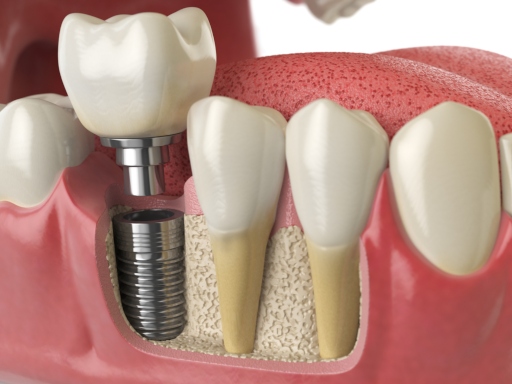 How Long Does the Dental Implant Process Take?