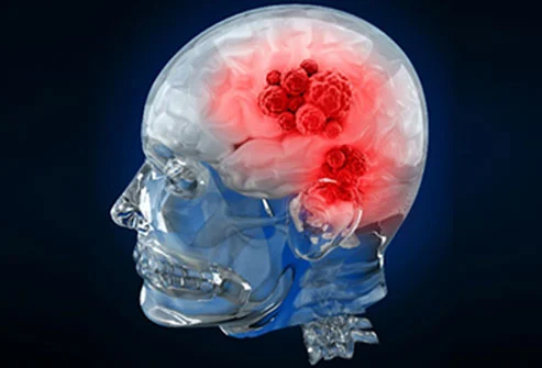 How Brain Tumors are Diagnosed and Treated