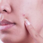 What are the skin cancer signs on face?