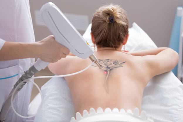 What to Expect With Laser Tattoo Removal