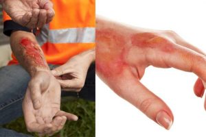 The Losses You Should Include When Claiming Compensation for a Burn Injury
