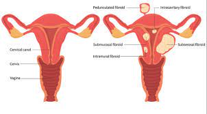 Uterine Fibroids Symptoms