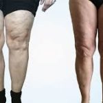 Cellulite in Legs