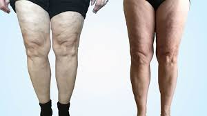 Cellulite in Legs